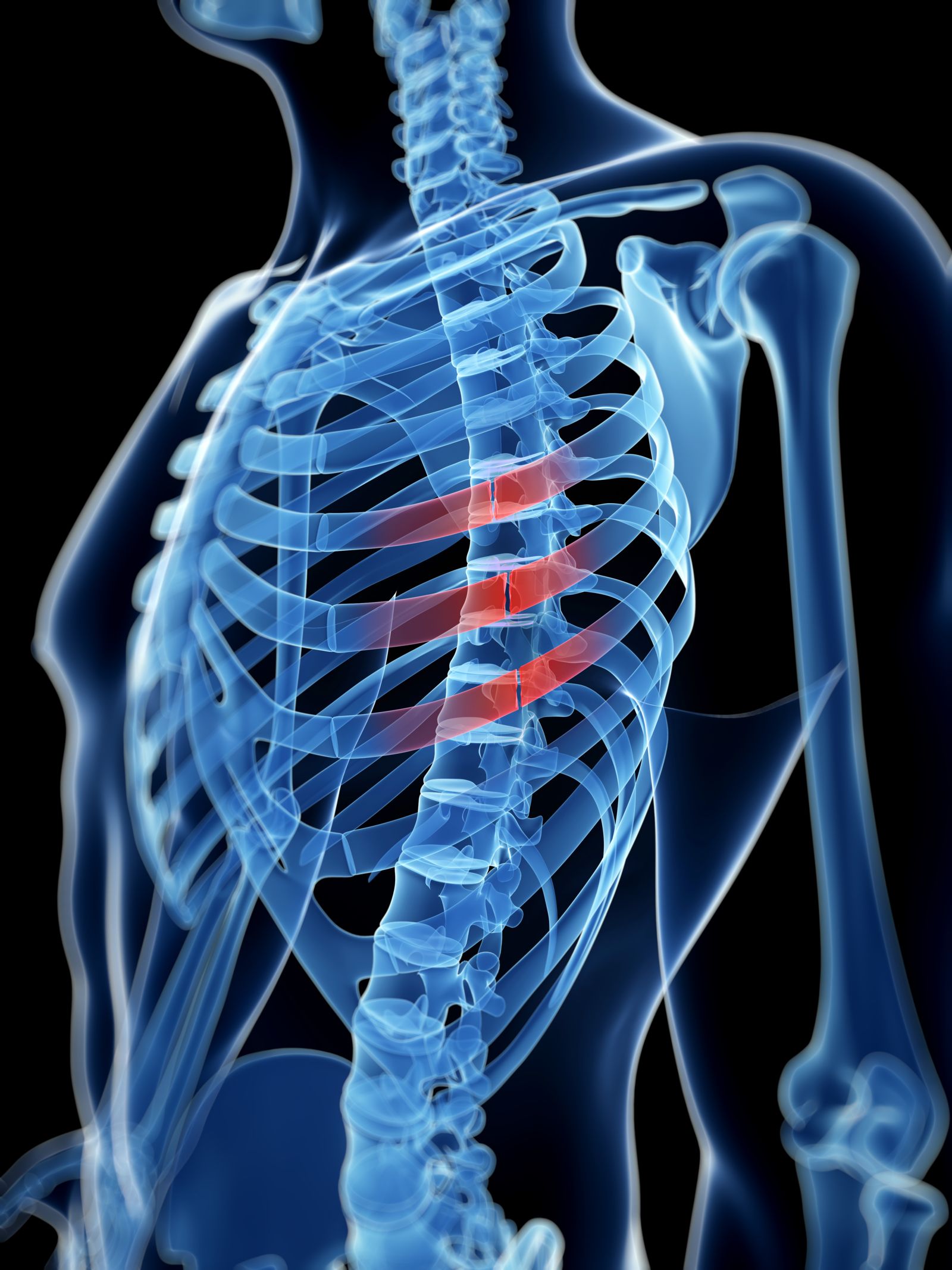 Rib Fractures From a Car Accident | Max Meyers Law PLLC